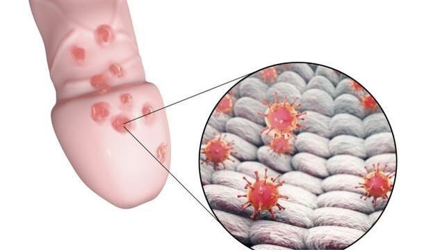 alergija na gel za povećanje penisa